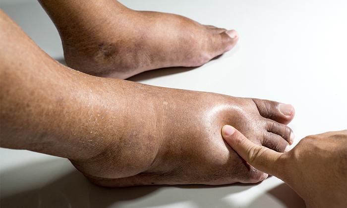Diabetic Foot Care