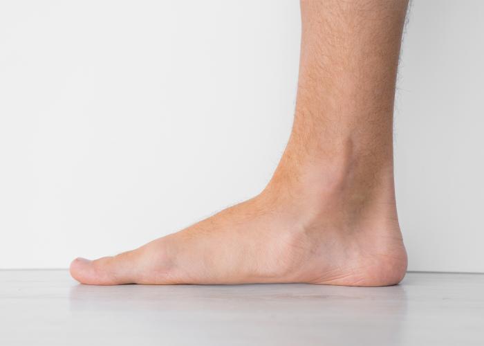 Flatfoot