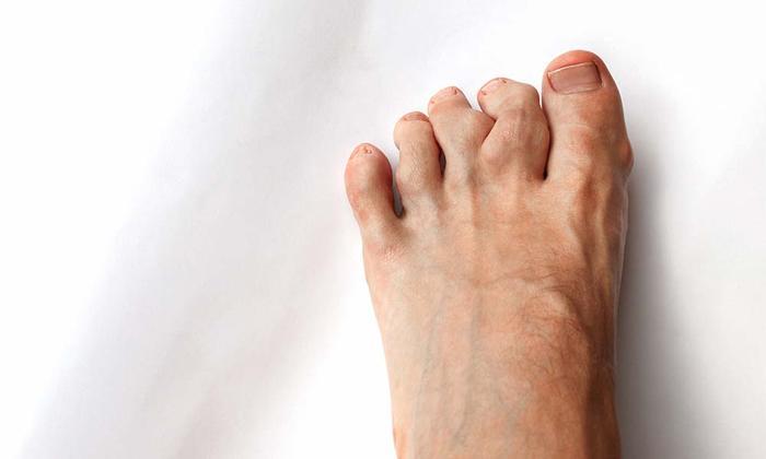 Hammertoes