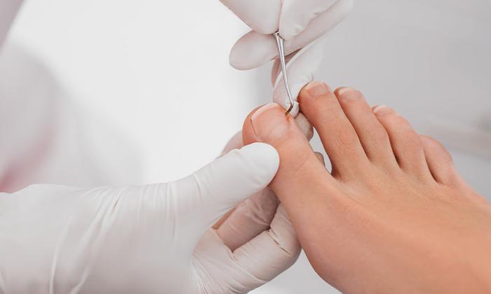 Ingrown Toenails